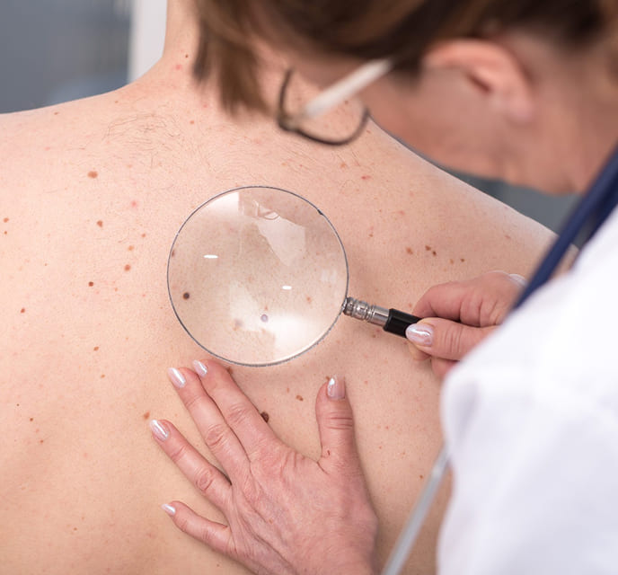 Tratamento para hidradenite supurativa