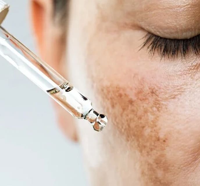 Tratamento para melasma